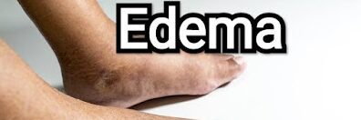 What is Edema ?